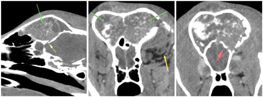 csontoldódást okozó homloküregi tumor CT felvétele